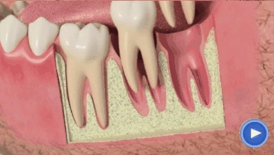 убыль костной ткани в области утраченных зубов и наклон соседних зубов