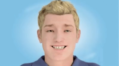 удаление зубов при недостаточном размере челюсти