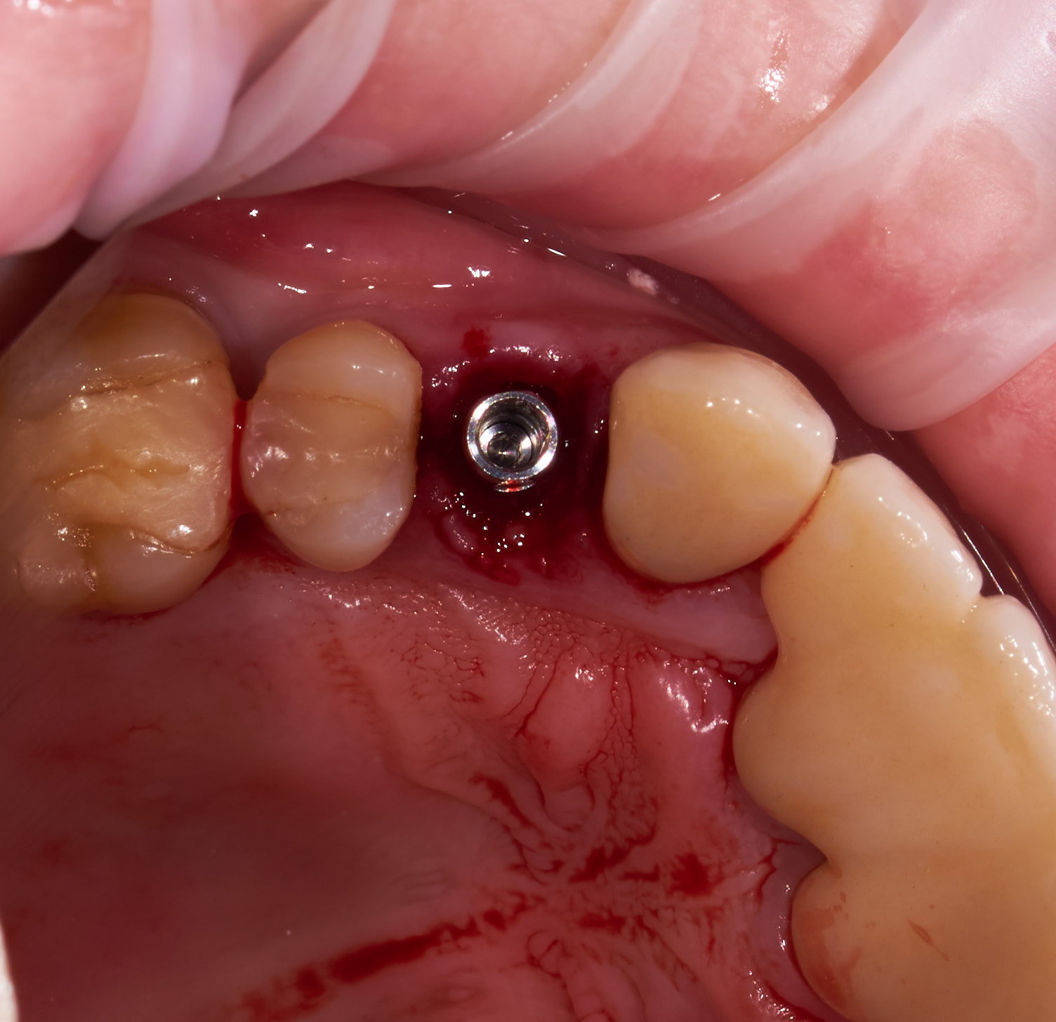 имплантат из титана – надежная замена корня зуба