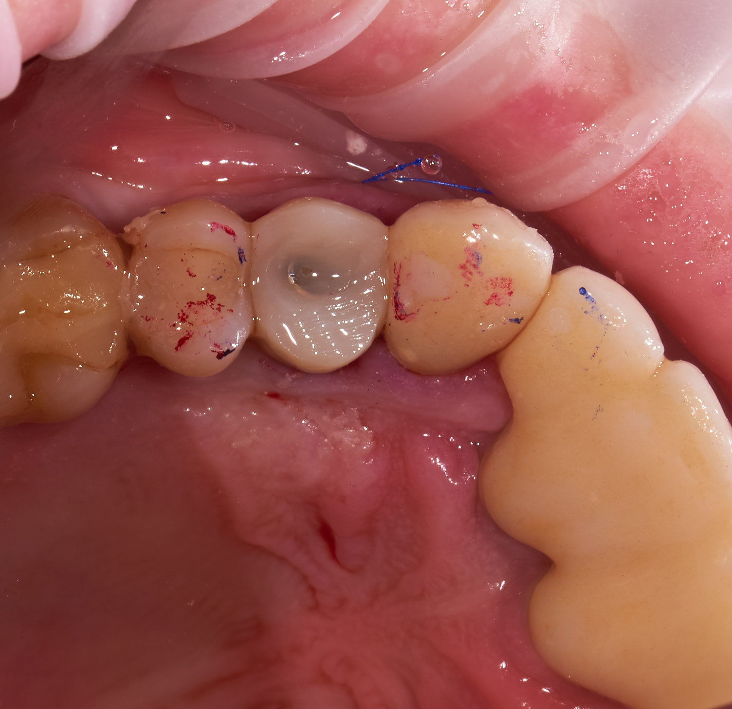 зуб восстановленный «временной» коронкой на имплантате
